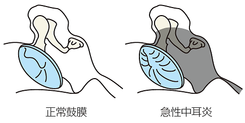 耳鼻咽喉科内藤クリニック 正常鼓膜、急性中耳炎