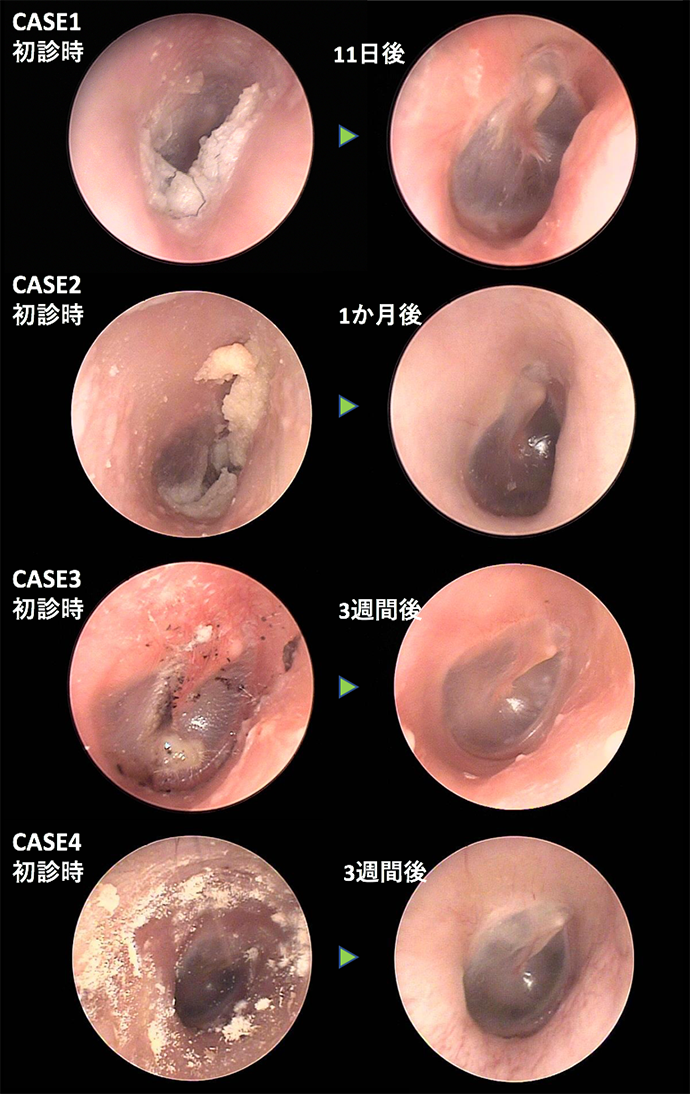 耳鼻咽喉科内藤クリニック 外耳道真菌症　CASE 1