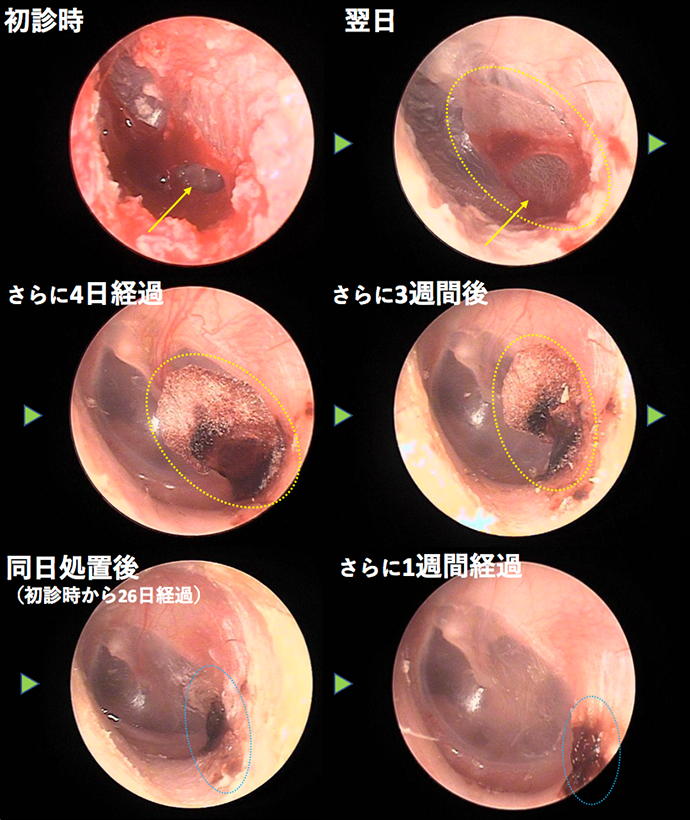 耳鼻咽喉科内藤クリニック 外傷性鼓膜穿孔　CASE 1