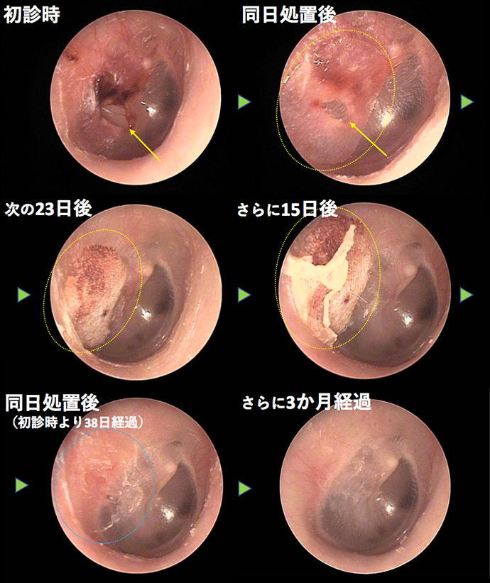 耳鼻咽喉科内藤クリニック 外傷性鼓膜穿孔　CASE2