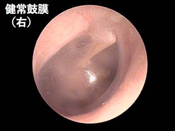耳鼻咽喉科内藤クリニック 右の健常鼓膜
