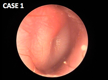 耳鼻咽喉科内藤クリニック 急性中耳炎 1歳女児