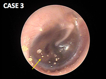 耳鼻咽喉科内藤クリニック 滲出性中耳炎（難治性） 6歳女児