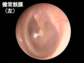 耳鼻咽喉科内藤クリニック 左の健常鼓膜