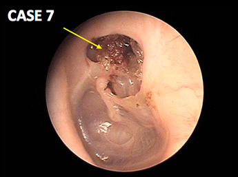 耳鼻咽喉科内藤クリニック 真珠腫性中耳炎（弛緩部型） 38歳女性
