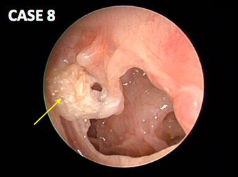 耳鼻咽喉科内藤クリニック 真珠腫性中耳炎（穿孔縁型） 78歳女性