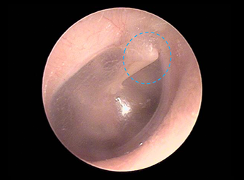 耳鼻咽喉科内藤クリニック 健常な鼓膜（右耳）