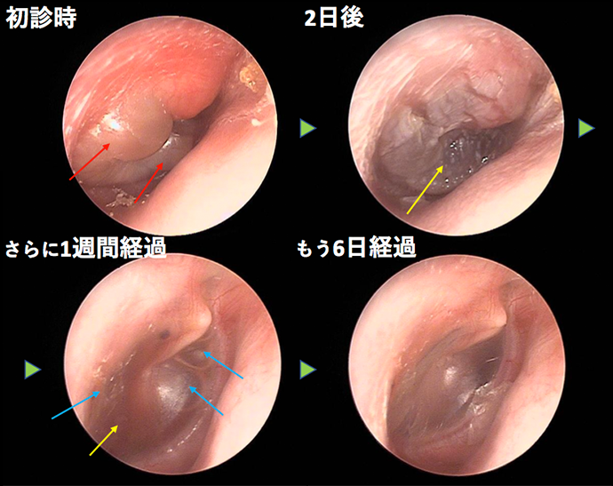 耳鼻咽喉科内藤クリニック 急性中耳炎（水疱形成）　CASE 3