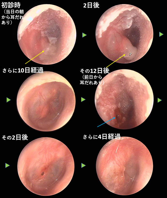 耳鼻咽喉科内藤クリニック 急性化膿性中耳炎　CASE 5