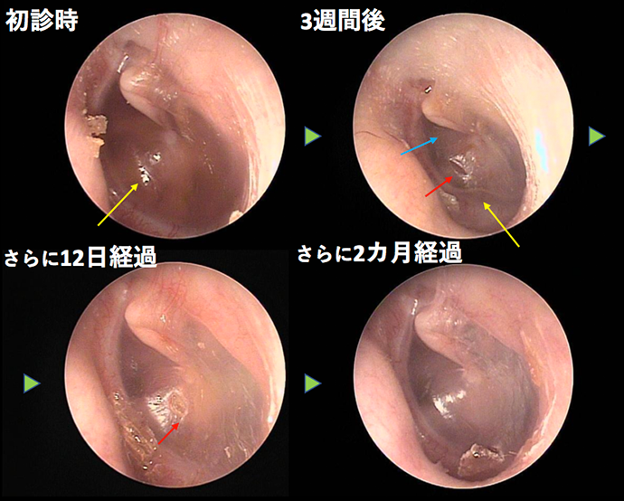 耳鼻咽喉科内藤クリニック 滲出性中耳炎（鼓膜切開実施）　CASE 2