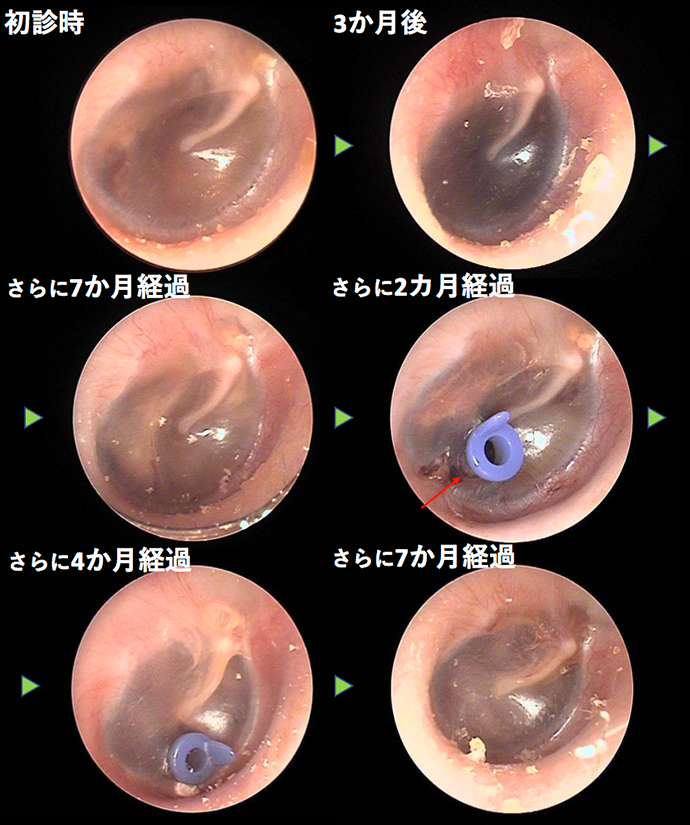 耳鼻咽喉科内藤クリニック 滲出性中耳炎（チュービング実施）　CASE 3