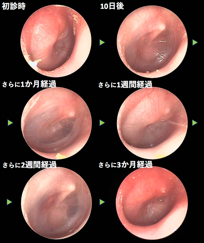 耳鼻咽喉科内藤クリニック 反復性中耳炎　CASE 1