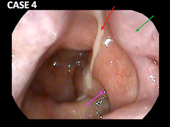 奥 鼻 異物 感 の 咽（喉）の不快感・違和感について