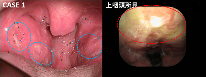 耳鼻咽喉科内藤クリニック 溶連菌感染