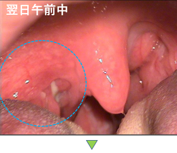 耳鼻咽喉科内藤クリニック 扁桃周囲膿瘍