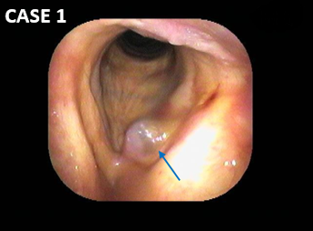 耳鼻咽喉科内藤クリニック 声帯嚢胞