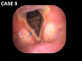 耳鼻咽喉科内藤クリニック 声帯嚢胞
