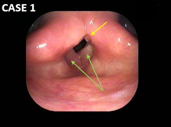 耳鼻咽喉科内藤クリニック ポリープ様声帯
