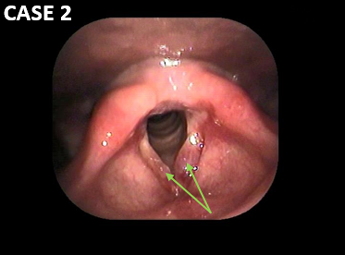 耳鼻咽喉科内藤クリニック ポリープ様声帯